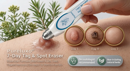 Pureluxo® Skin Tag Remover Roller🌟🏆