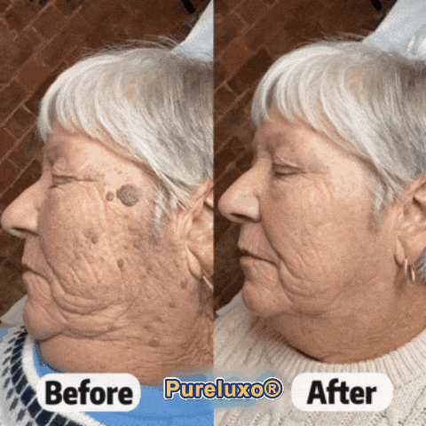 Pureluxo® Skin Tag Remover Roller🌟🏆