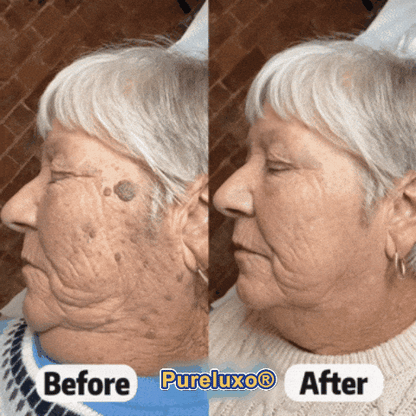 Pureluxo® Skin Tag Remover Roller🌟🏆