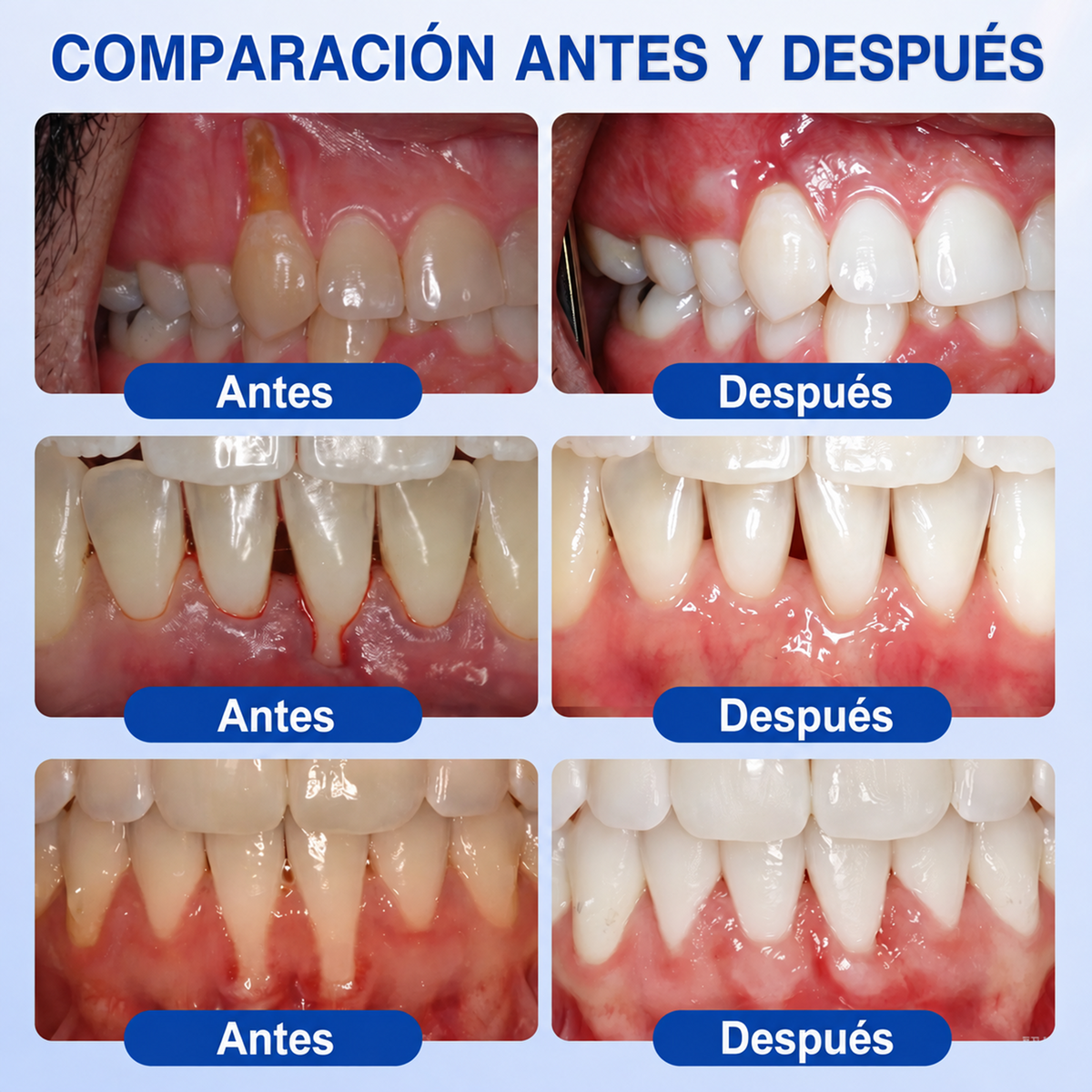 Pureluxo® 🦷Gel reparador periodontal GumRevive🔥
