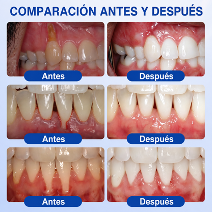 Pureluxo® 🦷Gel reparador periodontal GumRevive🔥