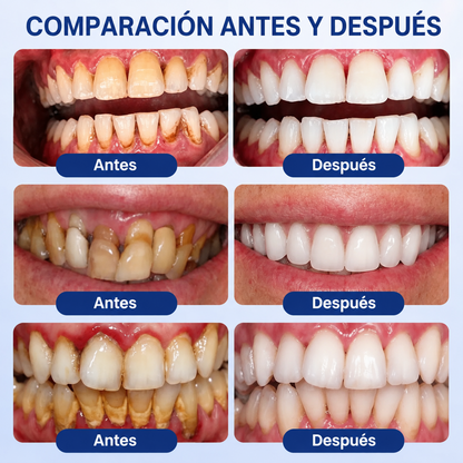 Pureluxo® 🦷Gel reparador periodontal GumRevive🔥