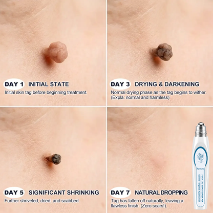 Pureluxo® Skin Tag Remover Roller🌟🏆